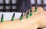 Moxibustion - heilende Wrme 